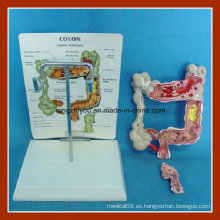 Vivid Colon y Rectum Common Disease Modelo